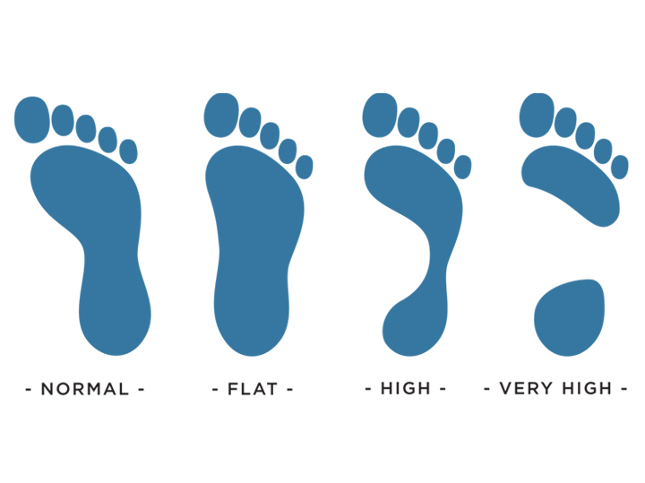 The 3 type of arches of foot